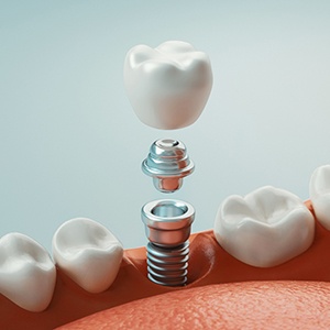 dental implant in Collegeville