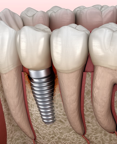 Illustration of infected gums and bone around a dental implant