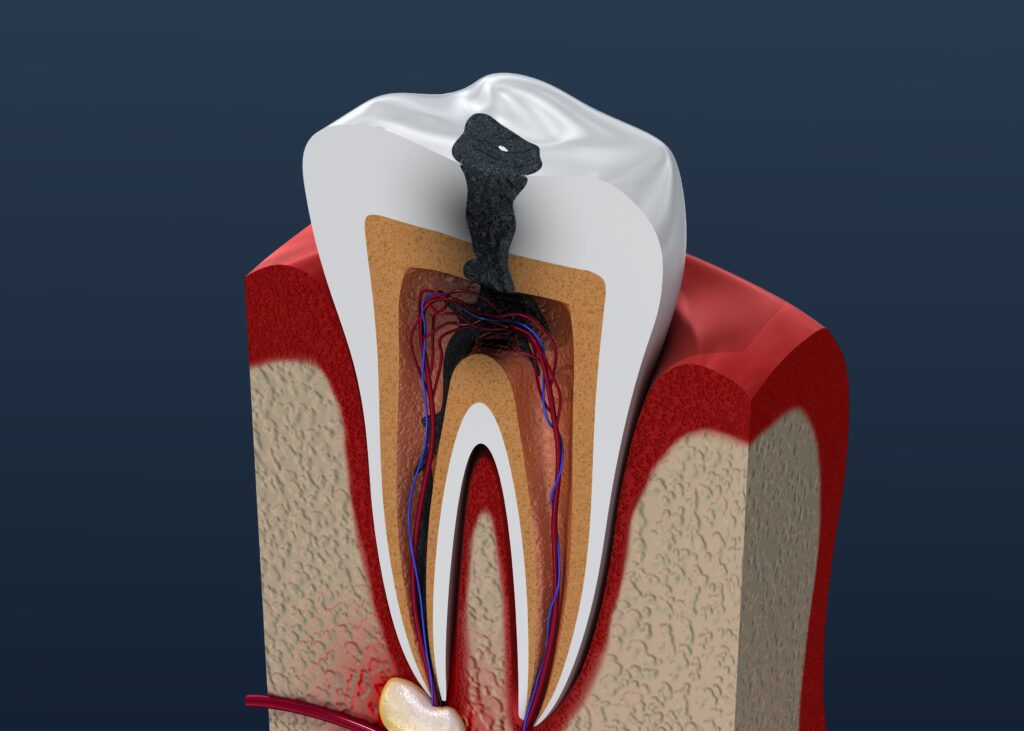 Cutaway diagram of a tooth with a large cavity in the center and navy background