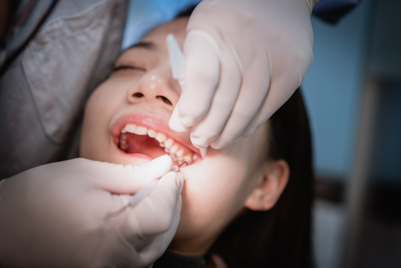 Root Canal Therapy in Collegeville, PA: Separating Myth from Reality About Saving Natural Teeth